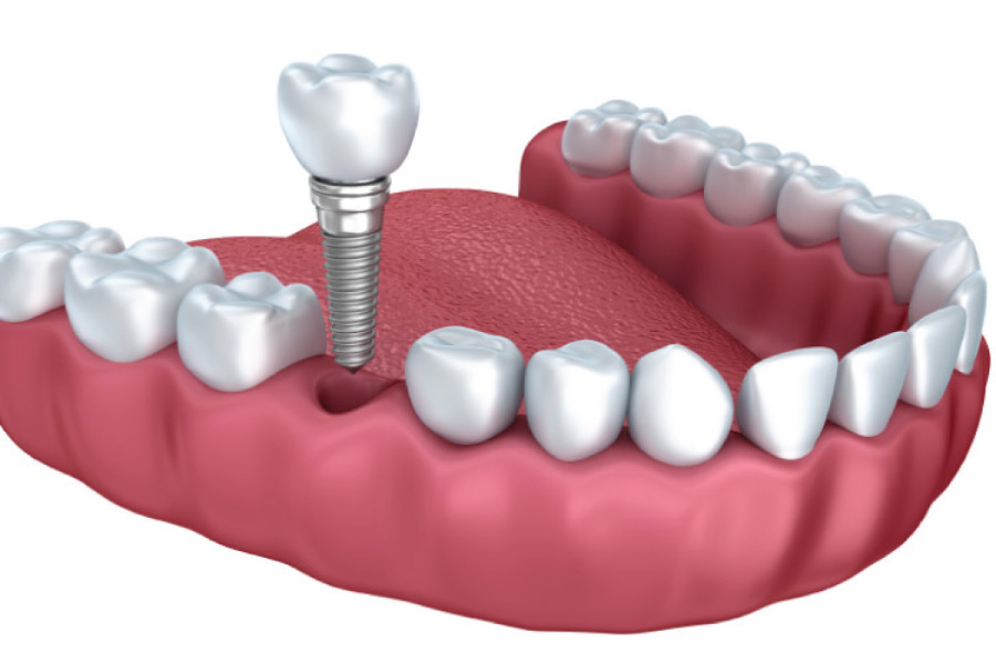 model of the lower jaw illustrating the dental implant process