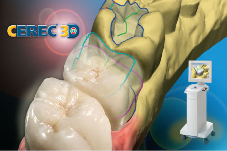 illustration of CEREC crown technology