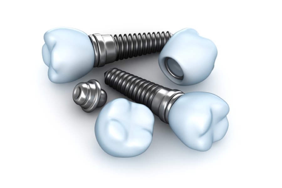 Everything to Know About Dental Implants High Point Dentistry