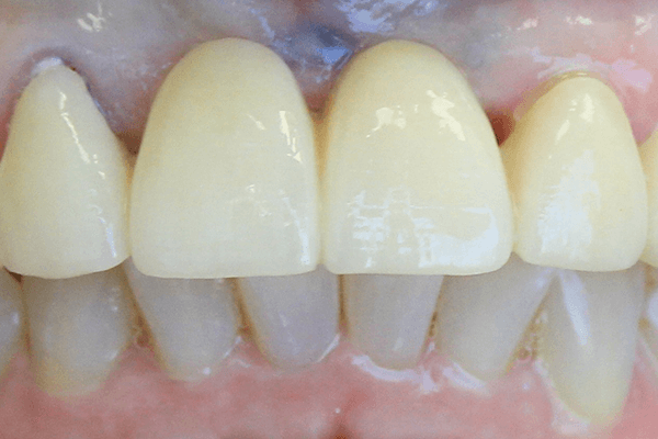 real patient's teeth after crowns