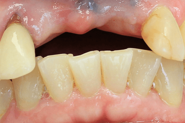 real patient's teeth before crowns