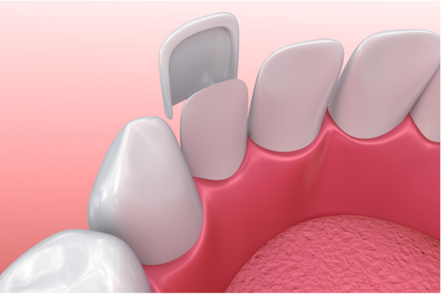 model of porcelain veneer procedure