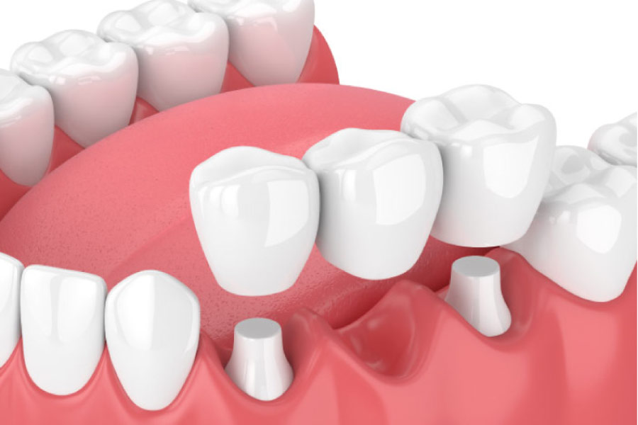 illustration of a dental implant bridge