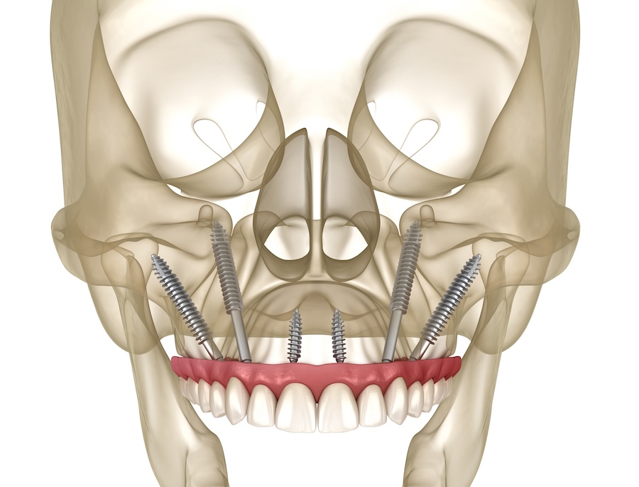 zygomatic dental implants, dental implants, High Point Dentistry, Elgin IL, Schaumburg IL, bone loss, dental prosthetics, implant solutions