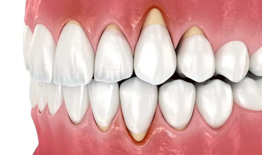 gum recession, dental health, gum grafting, High Point Dentistry, Elgin IL, Schaumburg IL, sensitive teeth, prevent gum disease