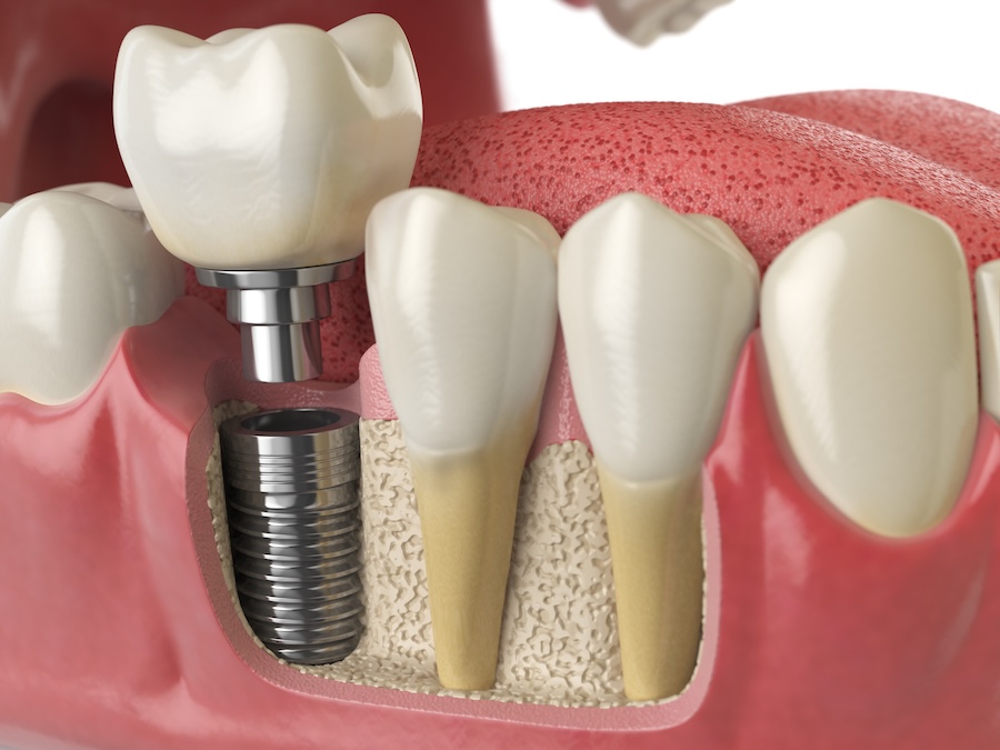 dental implants are dental implants worth it